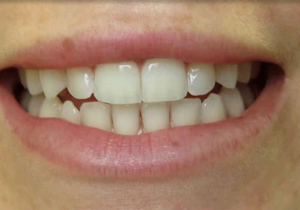 patient-3-before-link-dental-center