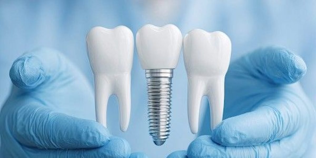 Does Denti-Cal Cover Dental Implants? What Patients Should Know
